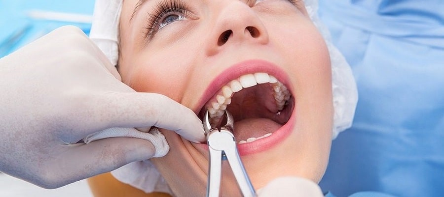 Tooth Extraction Surrey BC