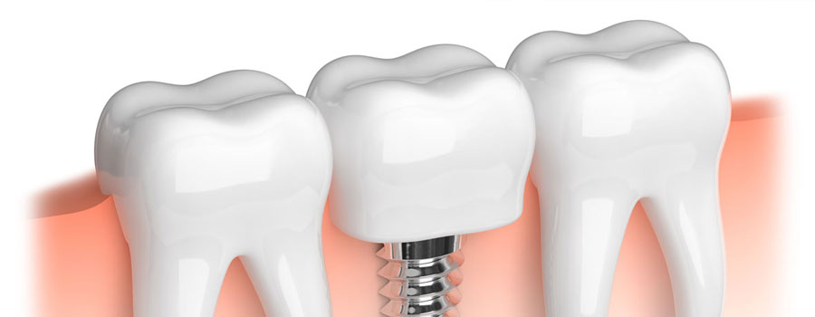 dental implants surrey bc